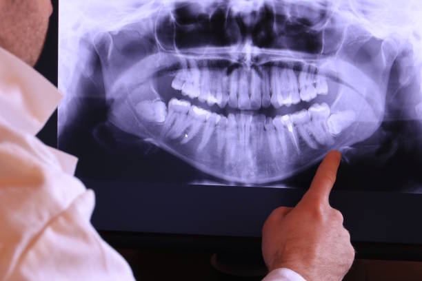 Best Emergency Dentist for Lost Fillings or Crowns in Painted Post, NY